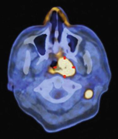 Fig. 10-8, Nasopharyngeal carcinoma.