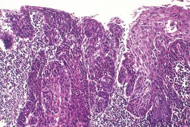 Fig. 10-9, NPC, keratinizing type.