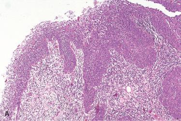 Fig. 10-10, Nasopharyngeal carcinoma, nonkeratinizing differentiated.