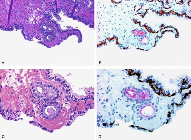 Fig. 9.11, Atypical small acinar proliferation (ASAP) highly suspicious for but not diagnostic of malignancy.