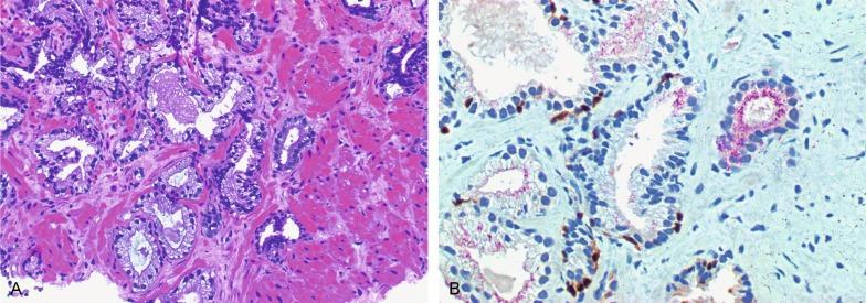 Fig. 9.12, Atypical small acinar proliferation (ASAP) highly suspicious for but not diagnostic of malignancy.