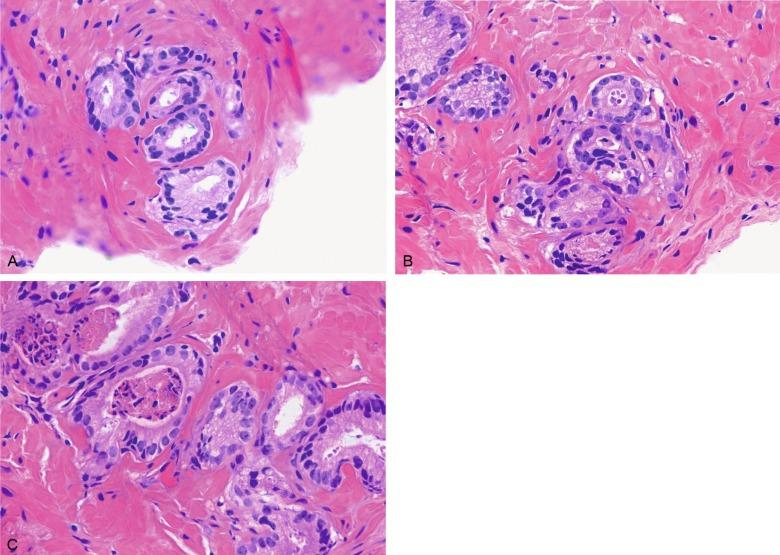 Fig. 9.13, Atypical small acinar proliferation highly suspicious for but not diagnostic of malignancy (ASAPH).