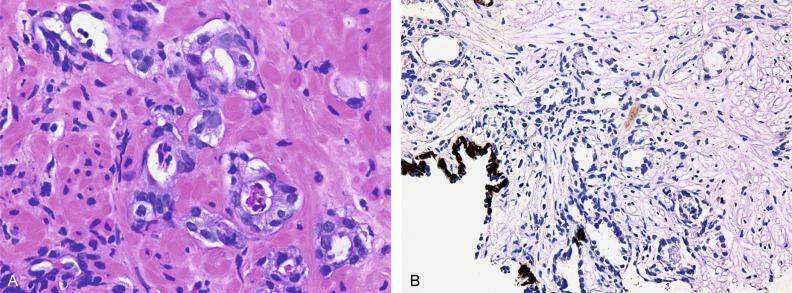 Fig. 9.14, Atypical small acinar proliferation.