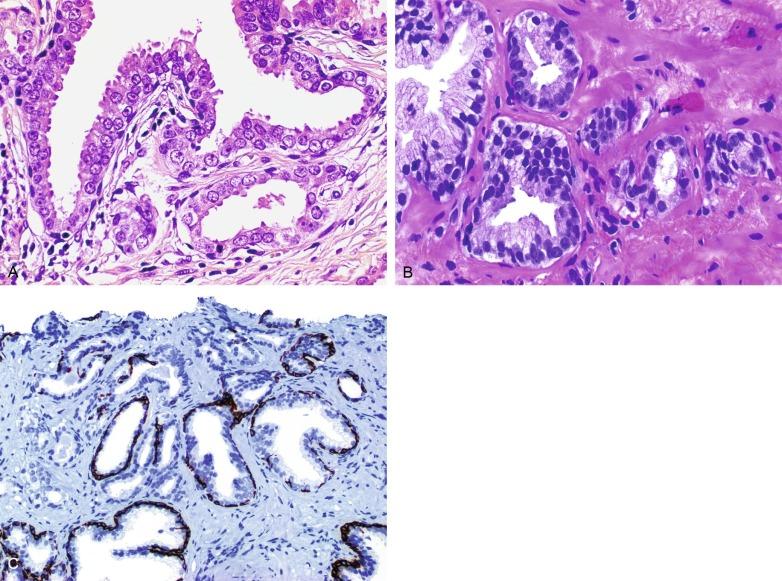 Fig. 9.16, Atypical small acinar proliferation (ASAP) + prostatic intraepithelial neoplasia (PIN).