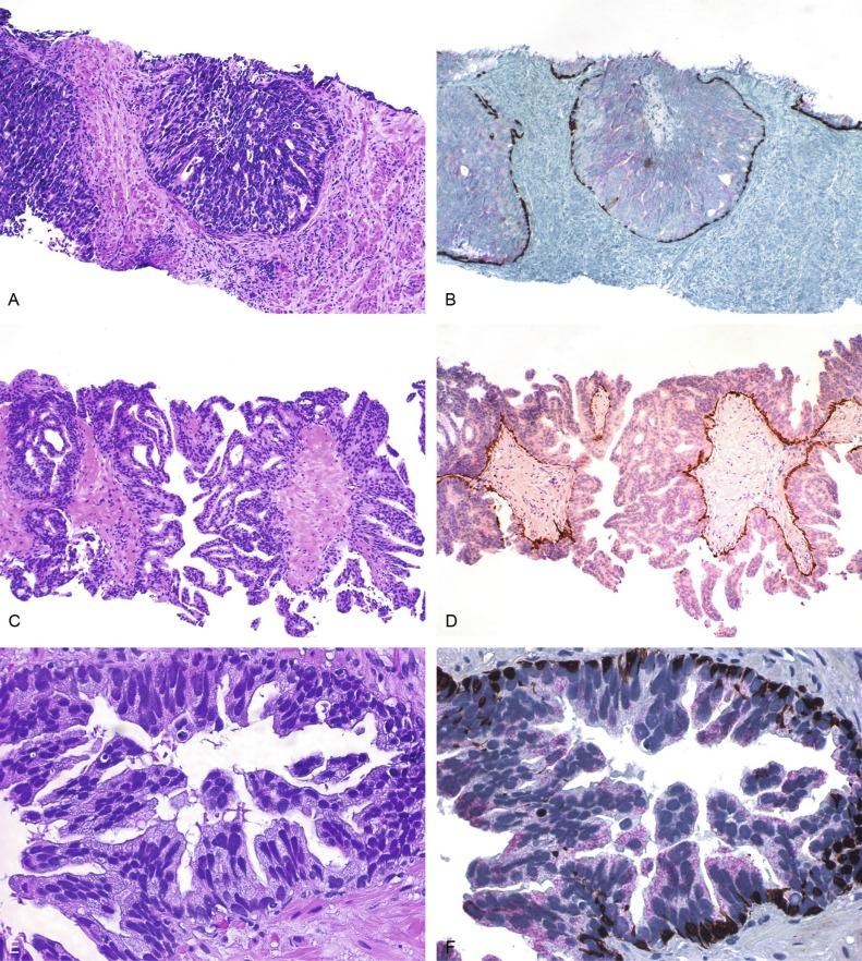 Fig. 9.17, Intraductal carcinoma.