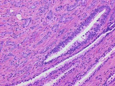 Fig. 9.19, Peripheral sinus at the edge of a nodule of nodular hyperplasia ( bottom right ) with “cancerization” of the nodule.