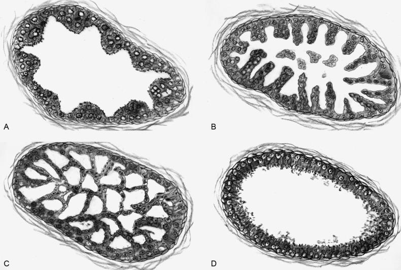 Fig. 9.2, Architectural patterns of high-grade prostatic intraepithelial neoplasia.