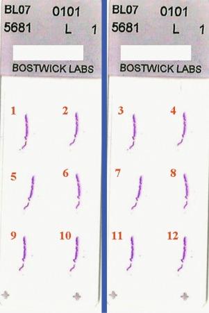 Fig. 9.21, Bostwick Laboratories' prostate biopsy slide protocol.