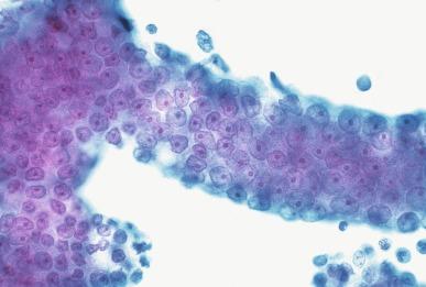 Fig. 9.22, Moderately differentiated prostatic adenocarcinoma on fine needle aspiration.