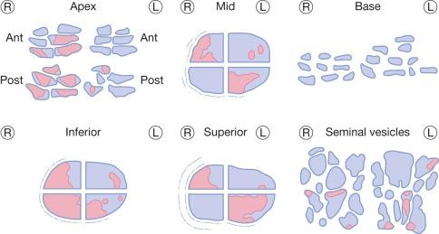 Fig. 9.24, Partial sampling protocol for preparing and reporting prostatectomy specimens.