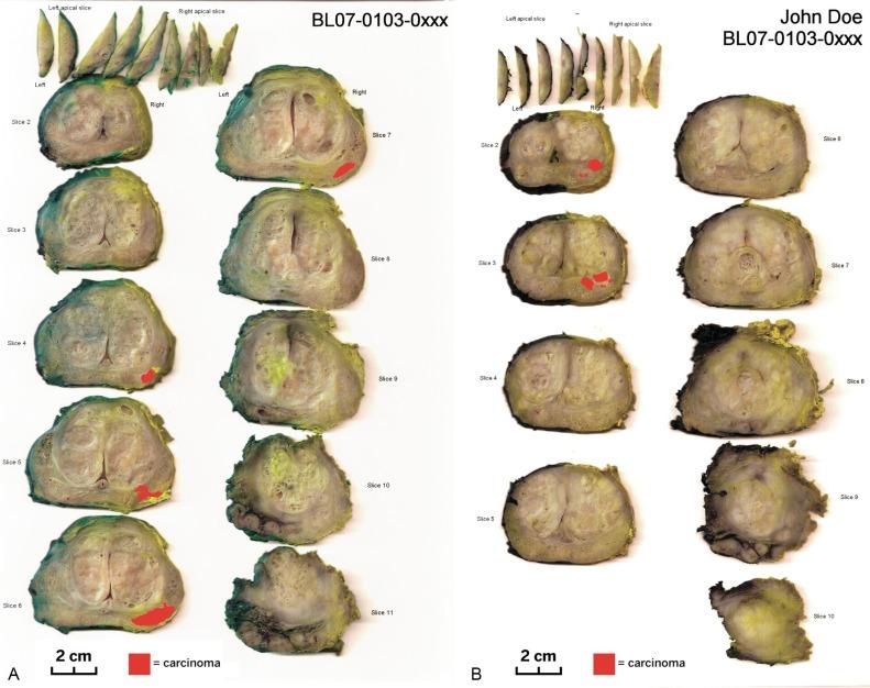 Fig. 9.25, Sample prostate cancer maps for prostatectomy specimens with complete sampling and whole-mount sections. Cancer is marked in red. (A) Unilateral, unifocal, organ-confined cancer. (B) Unilateral, multifocal (apparently), organ-confined cancer (pathologic stage T2aN0M0).(C) Bilateral, multifocal cancer with multifocal bilateral extraprostatic extension, seminal vesicle invasion, and multiple positive apical surgical margins.