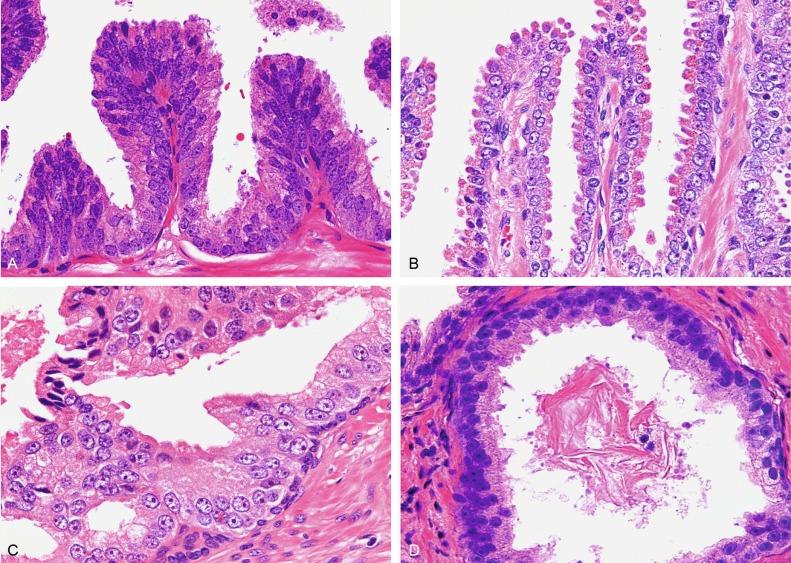 Fig. 9.3, Architectural patterns of high-grade prostatic intraepithelial neoplasia.