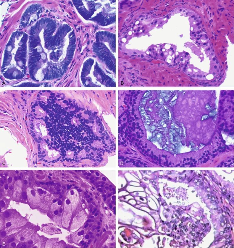 Fig. 9.4, Variants of high-grade prostatic intraepithelial neoplasia.