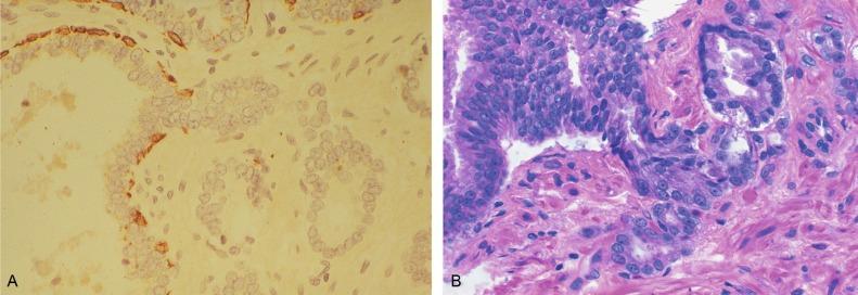 Fig. 9.6, Prostatic intraepithelial neoplasia (PIN) and microinvasion.