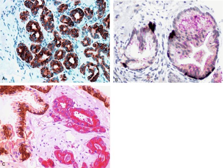 Fig. 9.8, Immunostain with antikeratin 34βE12 and racemase.