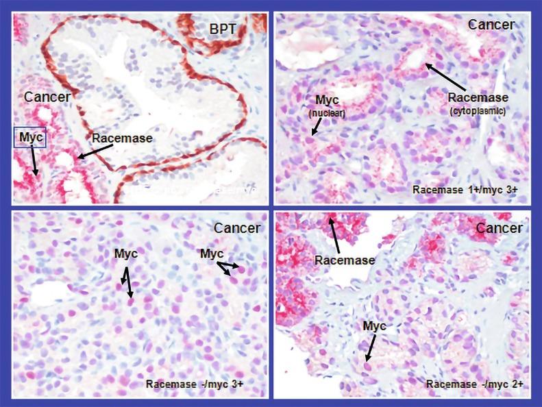 Fig. 9.9, Quadruple-antibody cocktail (keratin 34βE12/p63/racemase/c-Myc) staining in benign prostatic epithelium ( top left panel ) and cancer ( other three panels ). BPT, benign prostatic tissue.