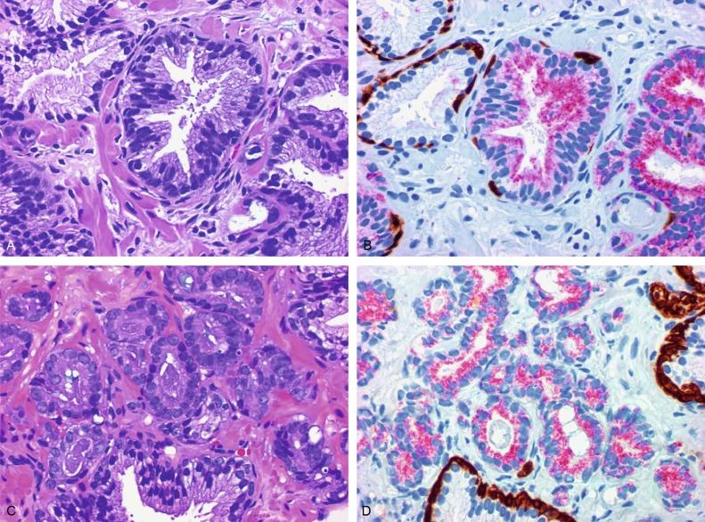 Fig. 9.10, Comparison of hematoxylin and eosin (H&E) and triple-antibody cocktail (keratin 34βE12/p63/racemase) staining.