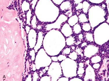 Fig. 20-11, Variant histologic findings in pleomorphic adenomas.