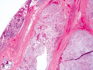 Fig. 20-12, Growth characteristics of pleomorphic adenoma.