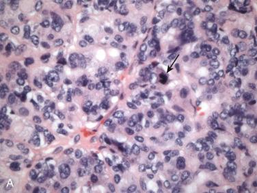 Fig. 20-13, Potential confounding findings in pleomorphic adenomas.