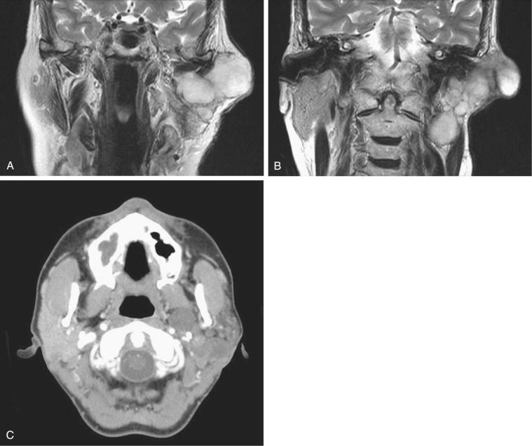 Fig. 20-14, Recurrent multinodular and multifocal pleomorphic adenoma.