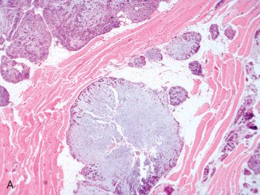 Fig. 20-15, Recurrent PA.