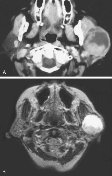 Fig. 20-16, Imaging features of Warthin tumor.