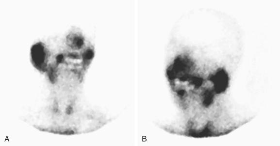 Fig. 20-17, Bilateral Warthin tumor.