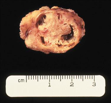 Fig. 20-18, Warthin tumor.