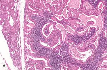 Fig. 20-20, Warthin tumor.