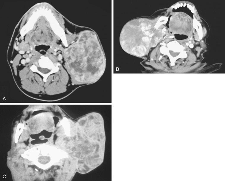 Fig. 20-2, Axial contrast-enhanced CT scans of three different patients.