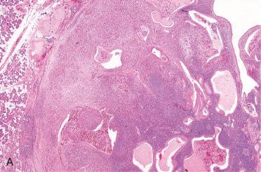 Fig. 20-22, Malignant transformation of WT.