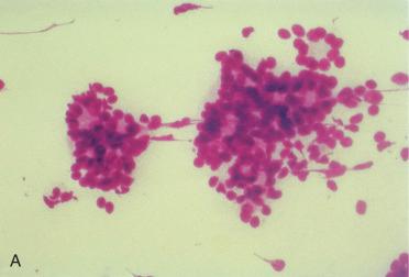 Fig. 20-24, Cytology of basal cell adenoma.