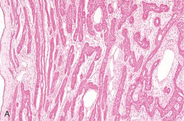 Fig. 20-26, Basal cell adenoma.