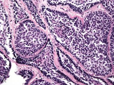 Fig. 20-27, Basal cell adenoma.