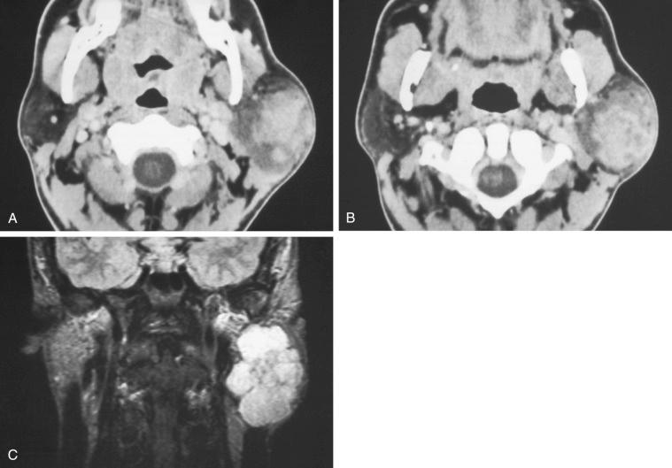 Fig. 20-3, CT and MR of pleomorphic adenoma.