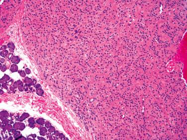 Fig. 20-31, Parotid gland oncocytoma.