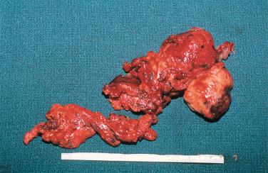 Fig. 20-32, Myoepithelioma.