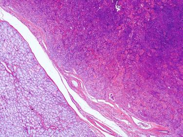 Fig. 20-33, Myoepithelioma of the palate.