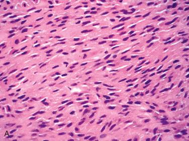 Fig. 20-35, Myoepithelioma.