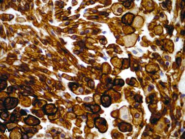 Fig. 20-36, Myoepithelioma.