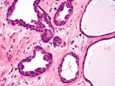 Fig. 20-38, Sclerosing polycystic adenosis.