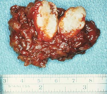 Fig. 20-4, Parotid pleomorphic adenoma.