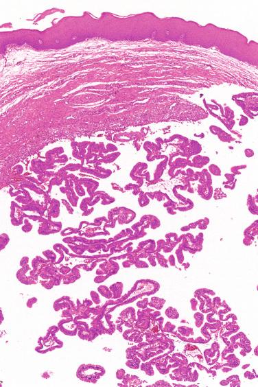 Fig. 20-41, Intraductal papilloma.