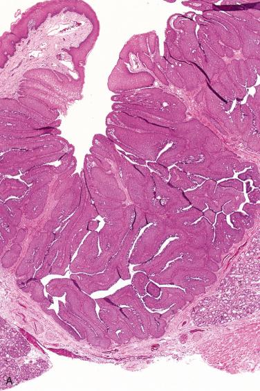 Fig. 20-42, Inverted ductal papilloma.