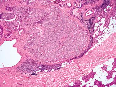 Fig. 20-43, Intercalated duct adenoma.