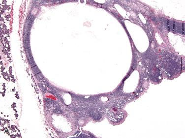 Fig. 20-45, Parotid gland sebaceous lymphadenoma.
