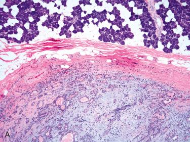 Fig. 20-6, Pleomorphic adenoma.