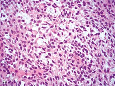 Fig. 20-8, Cellular myoepithelial-predominant pleomorphic adenoma.