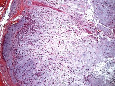 Fig. 20-9, Chondromyxoid predominant pleomorphic adenoma.